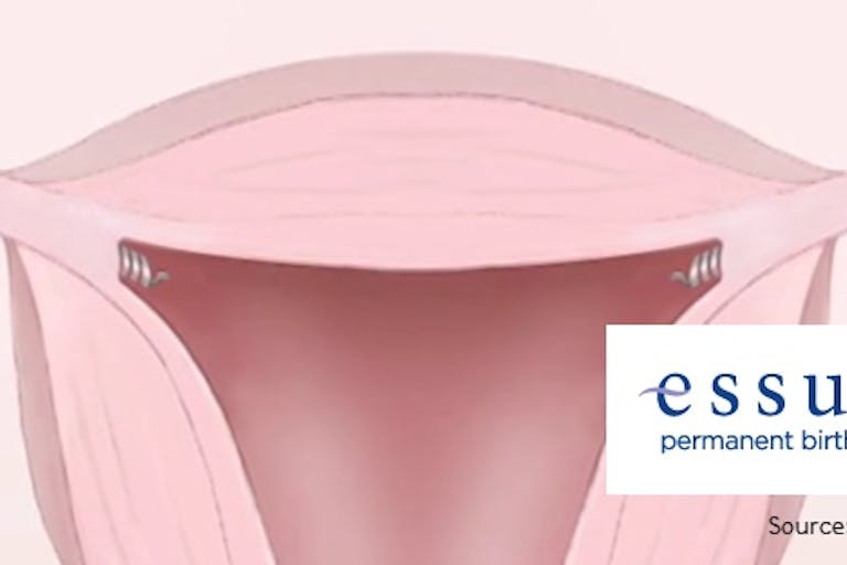 essure