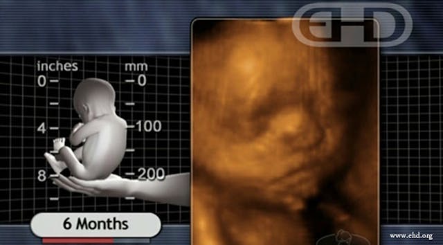 Preborn child at 6 months gestation (via ehd.org) Born at 6 months and weighing just 13 ounces, Dylan is a ‘fighter’ who just celebrated his first birthday image