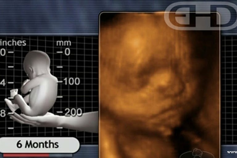 Preborn child at 6 months gestation (via ehd.org) Born at 6 months and weighing just 13 ounces, Dylan is a ‘fighter’ who just celebrated his first birthday image