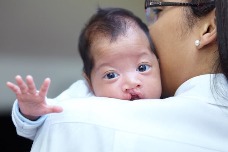 cleft lip, cleft palate, abortion