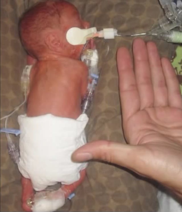 Leroy Carhart aborts babies just like this one, who was born prematurely and survived.