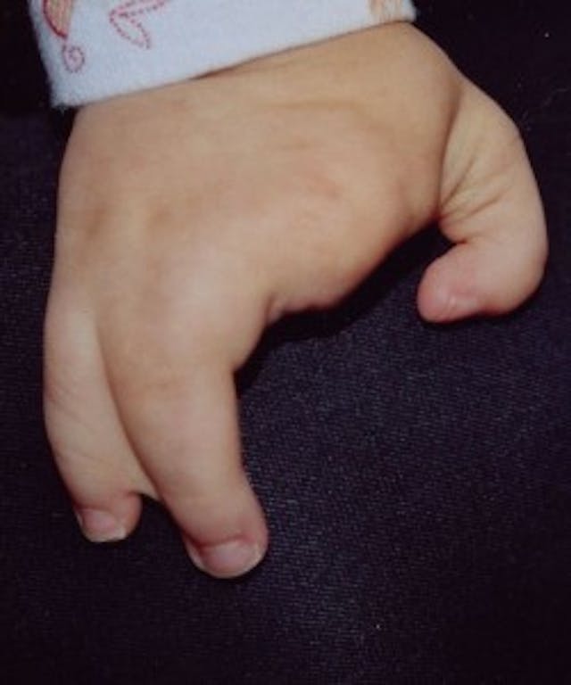 Cleft hand of a one-year-old. This is what the Australian parents thought was worthy of death. Cleft hand of a one-year-old. This is what the Australian parents thought was worthy of death. (Photo credit: Wikipedia)