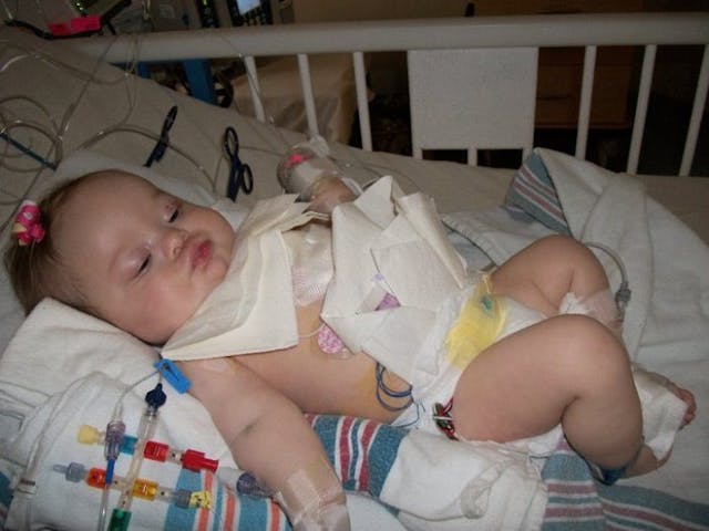 Ollie on day two after heart surgery (Photo: Annie Reid/Facebook) From Ollie to Edie: Family of two girls with Down syndrome say ‘life is better’ with them in it image