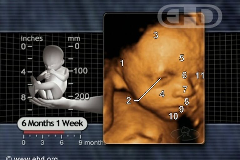 25 weeks. ‘Paranoid’ abortionist on trial for leaving skull fragment in late-term abortion patient image