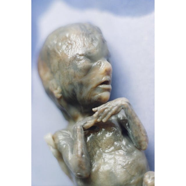 Baby aborted by saline method. From Citizens for a Pro-Life Society. Baby aborted by saline method. From Citizens for a Pro-Life Society.