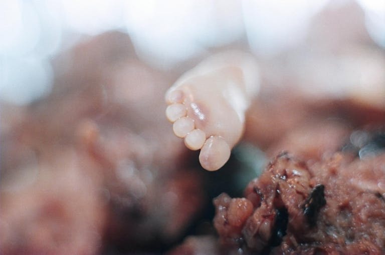 abortion