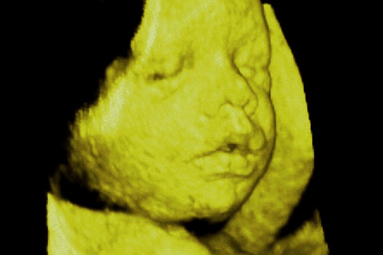 Fetus, 3D Sonography