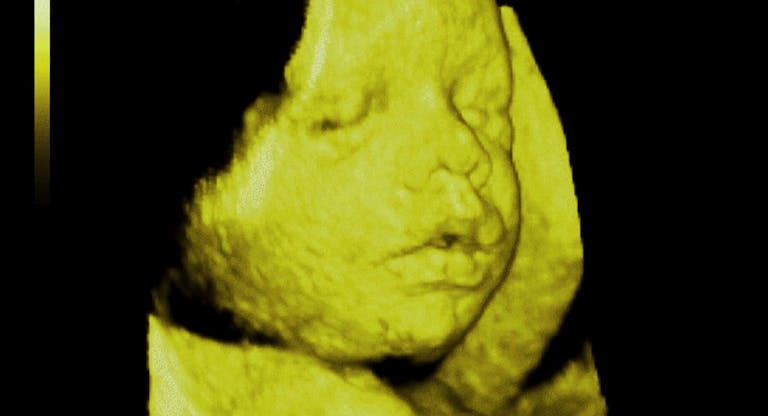 Fetus, 3D Sonography