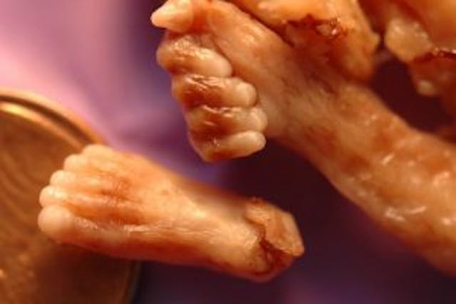 Foot and hand from a baby aborted at 16 weeks. Photo credit: Citizens for a Pro-Life Society.