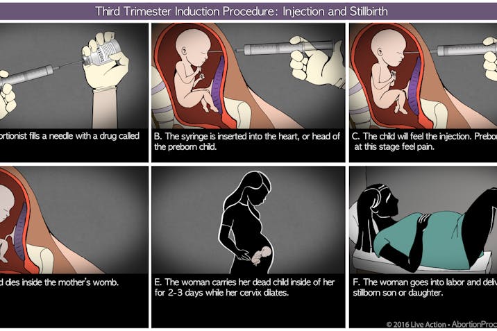 Third Trimester induction diagram 6 panel