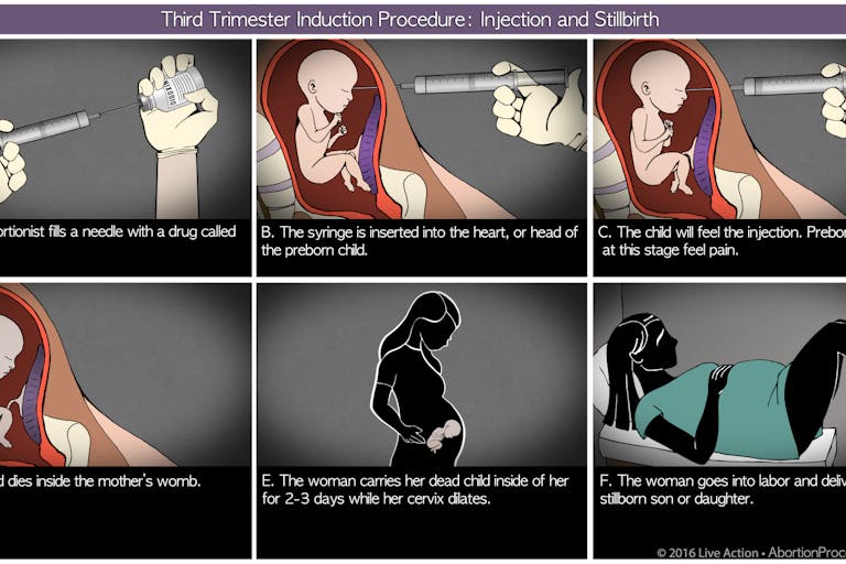Third Trimester induction diagram 6 panel