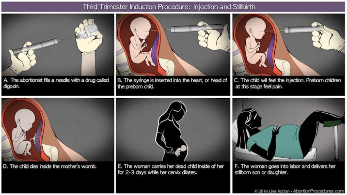 Third Trimester induction diagram 6 panel