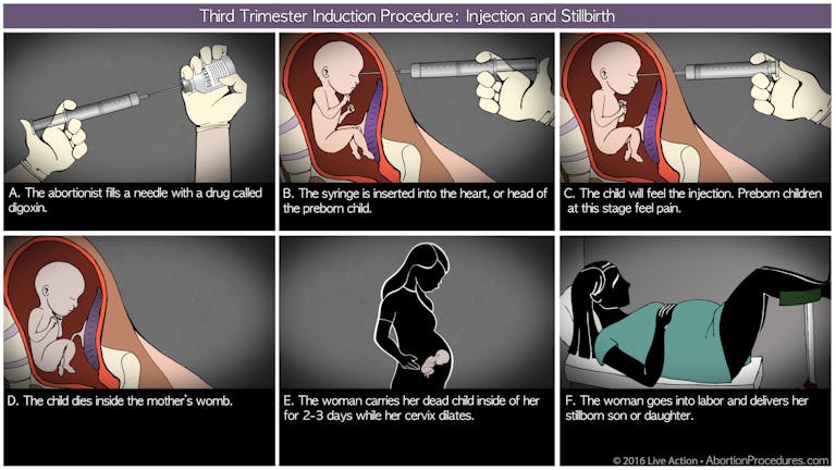 Third Trimester induction diagram 6 panel