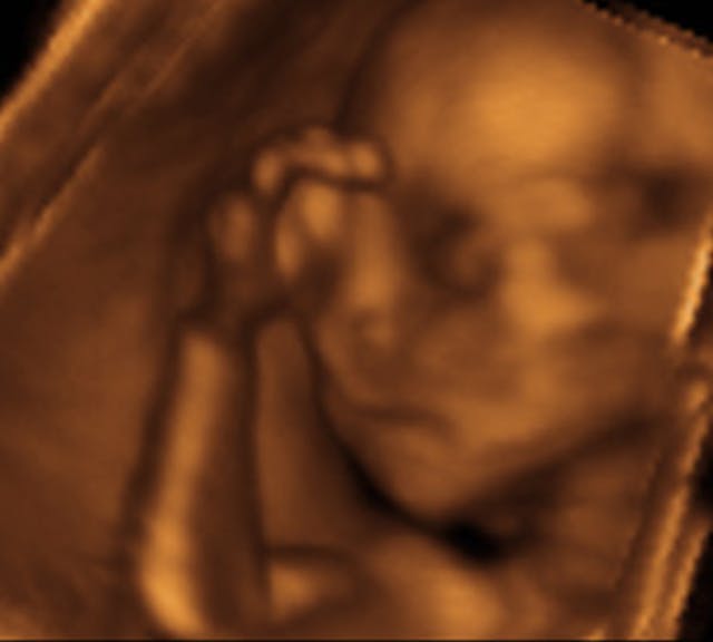 Fetal facepalm