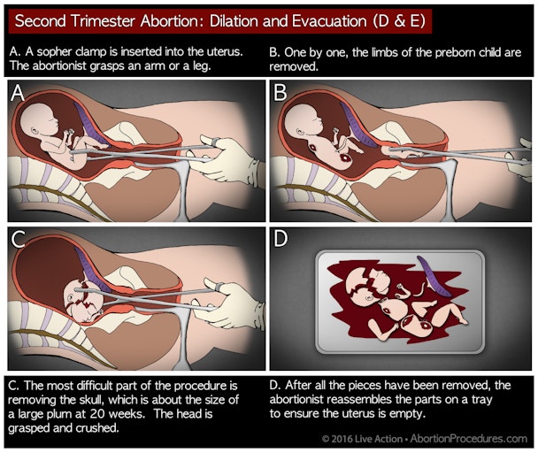 Requests for this procedure at Planned Parenthood were sent to the top of the queue.