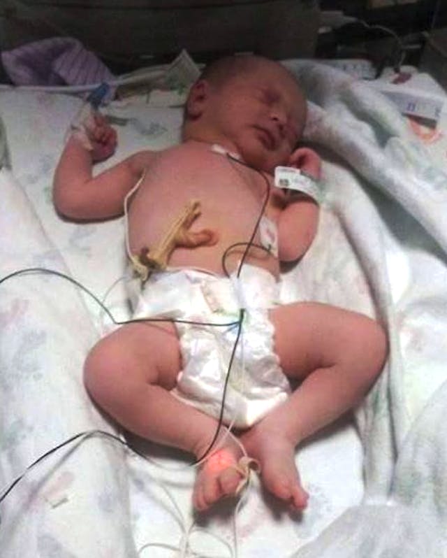 baby saved from abortion