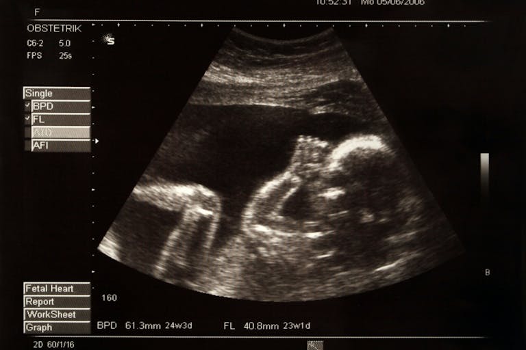 ultrasound, Alabama