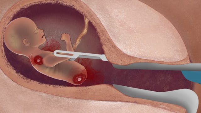 WATCH: Live Action’s new video series shows the horrifying reality of a D&E abortion image