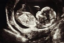 ultrasound, pregnant, Ireland, abortion, rape, abortions, pregnancy resource center, ultrasound