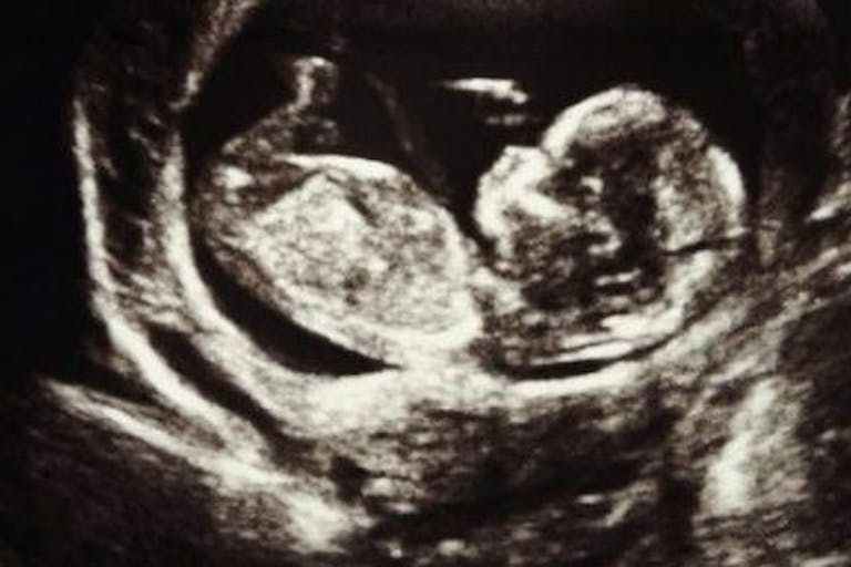 ultrasound, pregnant, Ireland, abortion, rape, abortions, pregnancy resource center, ultrasound
