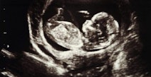 ultrasound, pregnant, Ireland, abortion, rape, abortions, pregnancy resource center, ultrasound
