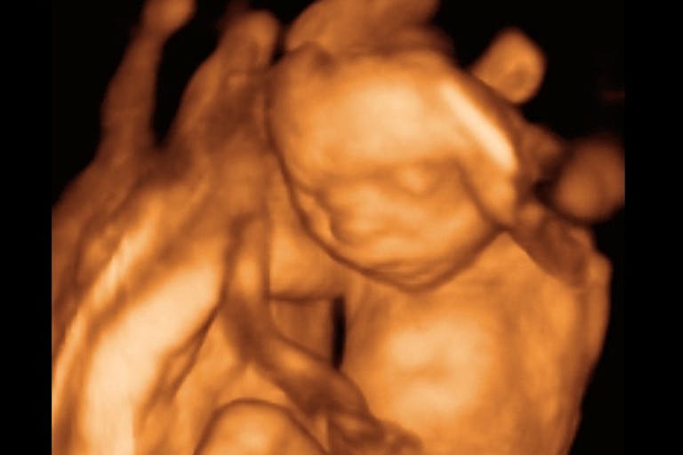 20 week ultrasound 20-wk-ultrasound