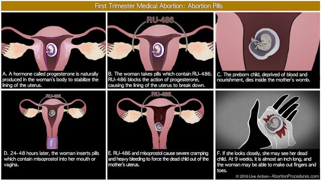 Medical abortion - six panel