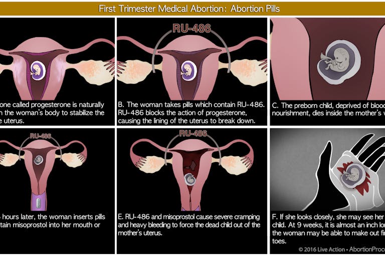 Medical abortion Medical abortion - six panel