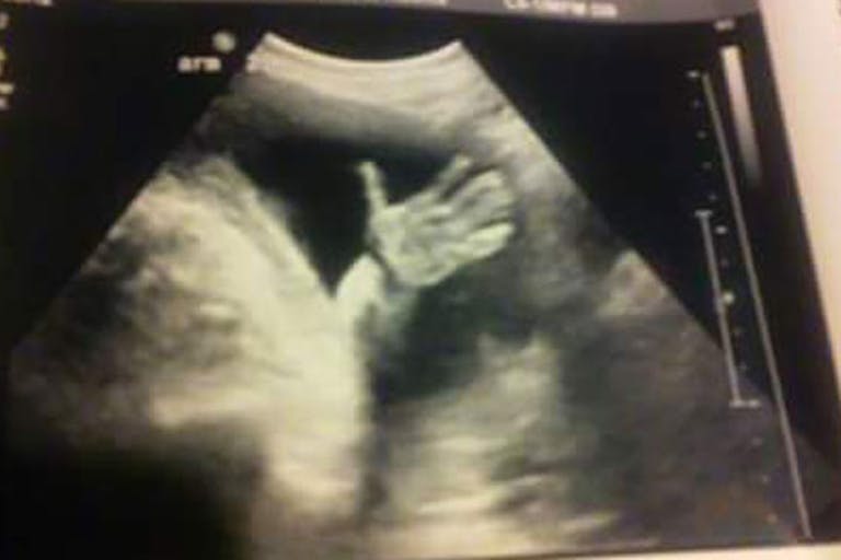 ultrasound-wave-baby