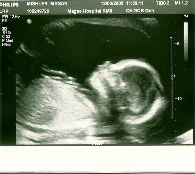 Don’t use my ‘hard case’ pregnancies to justify abortion image