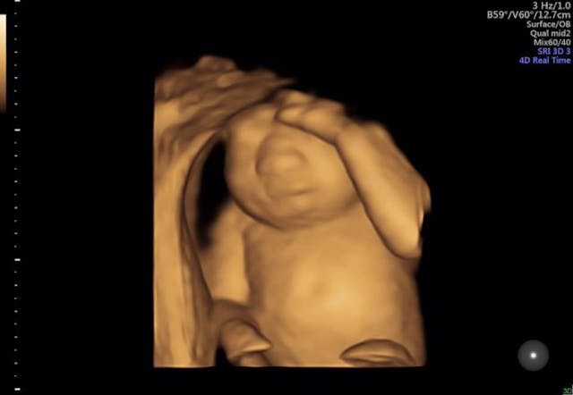 Mom who chose to carry terminally ill daughter to term to donate organs has given birth image