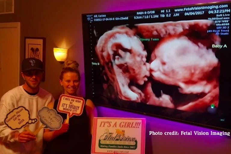 KissingTwins Ultrasound shows twin girls cuddling at 26 weeks, when late-term abortions are performed featured image