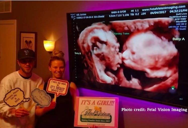 Ultrasound shows twin girls cuddling at 26 weeks, when late-term abortions are performed featured image