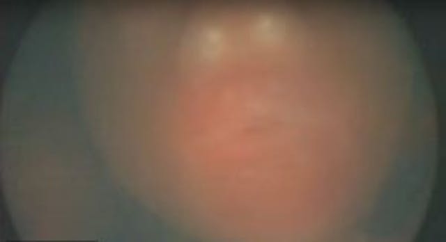 The tiny face of one one of the twins can be seen in this screenshot of the video. screenshot twin to twin surgery video