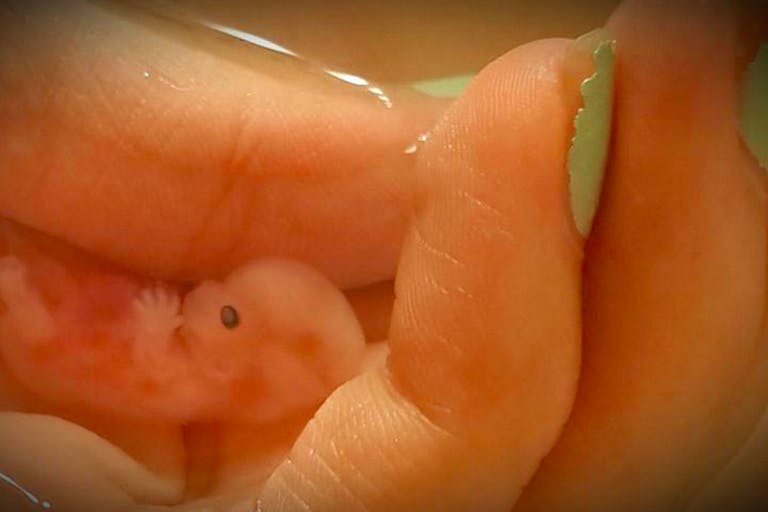 Annabelle, at 8 weeks, 5 days old. Her mother shared her beautiful story and photos here, illustrating the absolute humanity of preborn children.