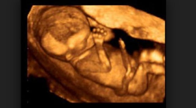 abortion, babies, fetus, Hyde Amendment