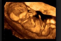 abortion, babies, fetus, Hyde Amendment