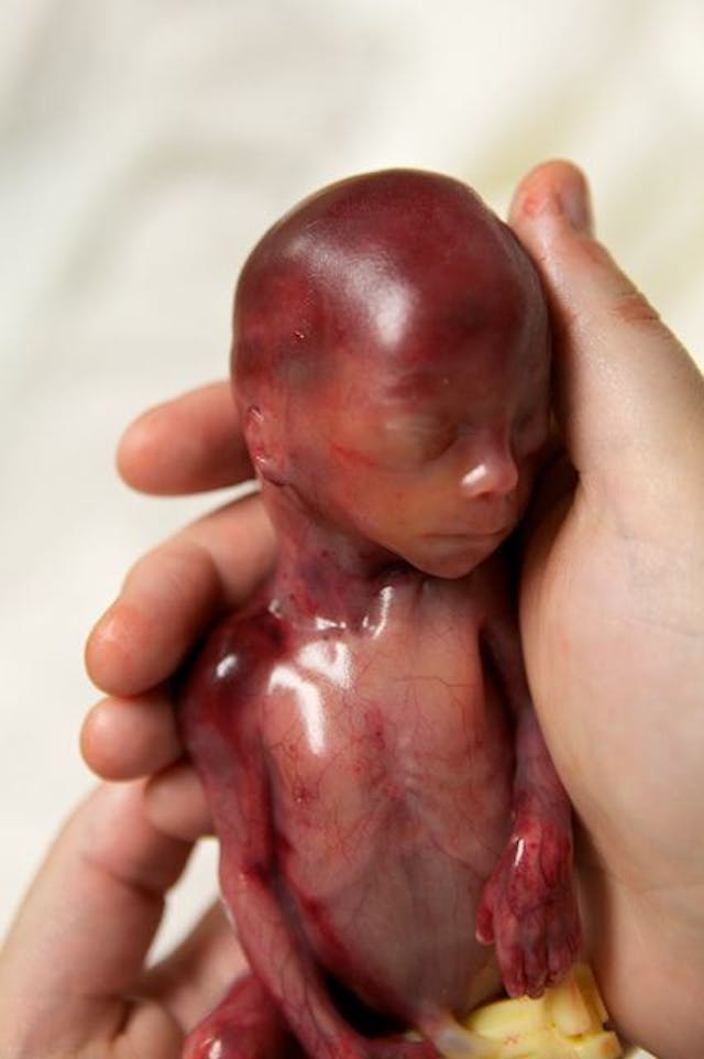 Walter Joshua Fretz who lived 19 weeks. Credit: Lexi Fretz & F2 Photography Walter Joshua Fretz who lived 19 weeks.