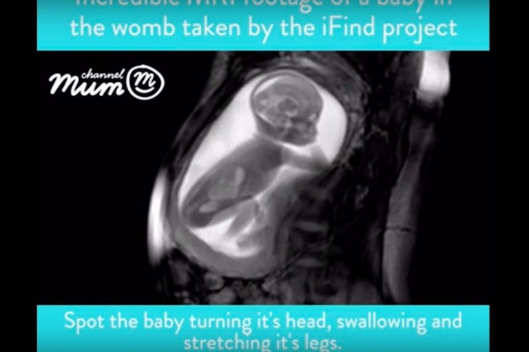 MRI, unborn child, kick, 20 weeks