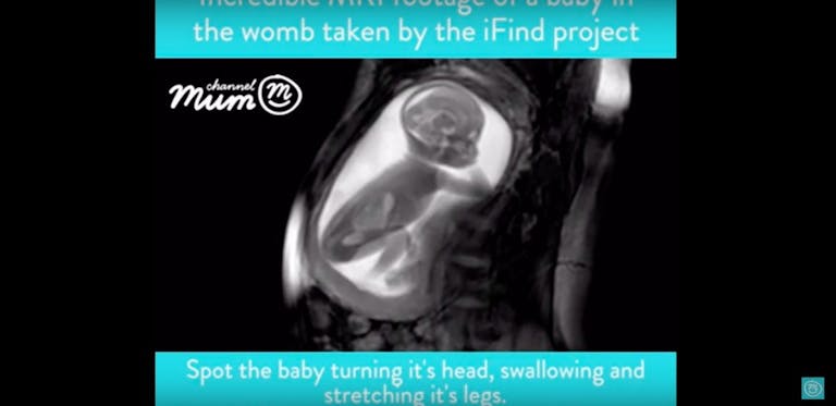 MRI, unborn child, kick, 20 weeks