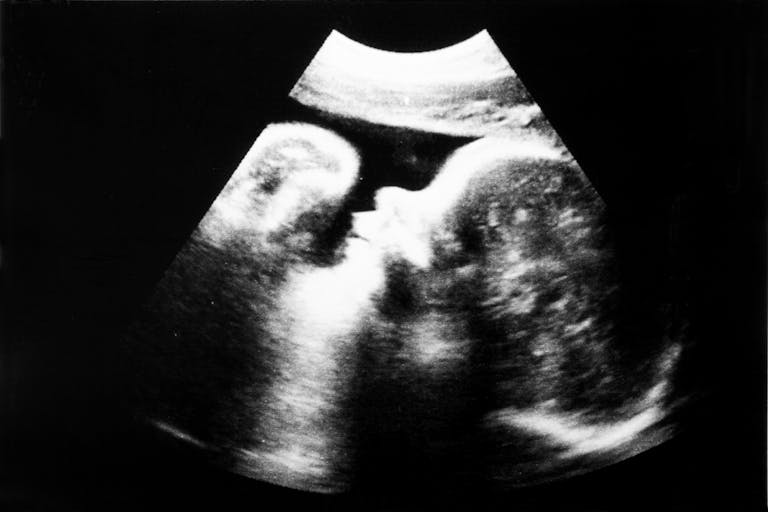 ultrasounds-baby-face