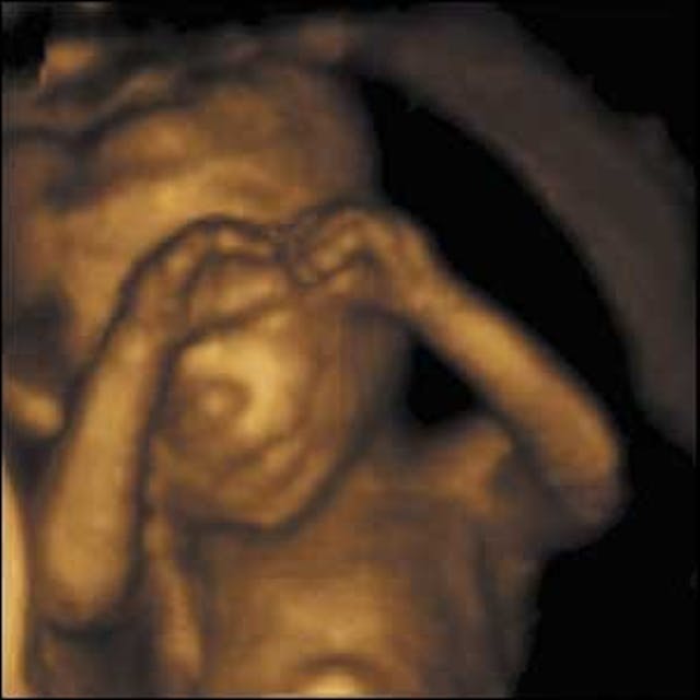 ultrasound, baby
