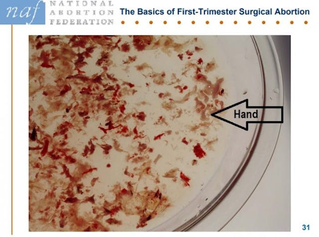 NAF Slide products of conception abortion at nine weeks gestation (7 weeks after fertilization) Image: NAF Slide products of conception abortion at nine weeks