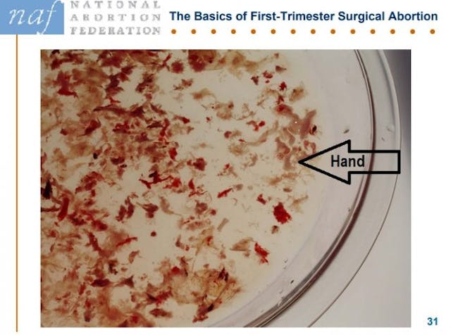 Image: NAF Slide products of conception abortion at nine weeks