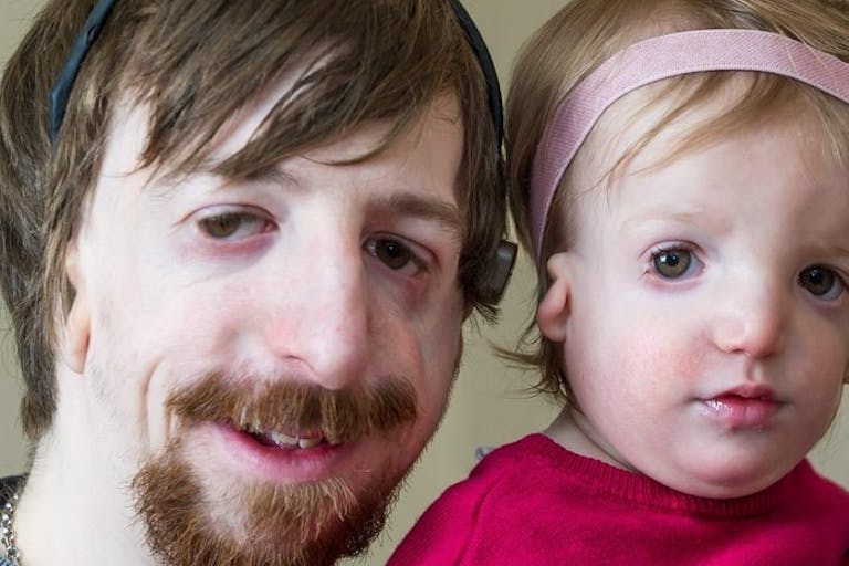 The Moore family from Norwich father and daughter have TreacherThe Moore family from Norwich father and daughter have Treacher Collins Syndrome