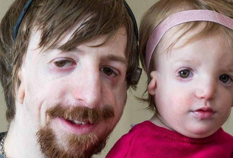 The Moore family from Norwich father and daughter have TreacherThe Moore family from Norwich father and daughter have Treacher Collins Syndrome
