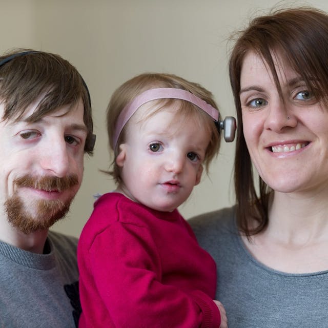 Alice Moore, 13 months who was born with the rare disease Treacher Collins Syndrome - her father Simon Moore, 30 also has the disease. Simon's wife Vicky Moore, 36 had IVF treatment to help conceive Alice as they so wanted to start a family together. See MASONS story MNFACE: A new dad with a severe facial disfigurement has defended his decision to have a baby daughter with the same condition. Simon Moore, 30, who is also profoundly deaf, has always been bullied and would hide indoors to avoid the stares of strangers. His life changed when his hearing dog Foggy, introduced him to Vicky, 36, at a sign language class five years ago and the pair married in 2012. They wanted a family so started IVF and made the decision to keep baby Alice when tests showed she also had the condition known as Treacher Collins Syndrome (TC). They had been offered a special IVF process which included state-of-the-art preimplantation genetic diagnosis to screen for the TC gene that Simon carried. The treatment would search for and destroy any embryos that carried the faulty gene. But after speaking to their family they opted for traditional IVF because they feared the screening process could leave them with no embryos.