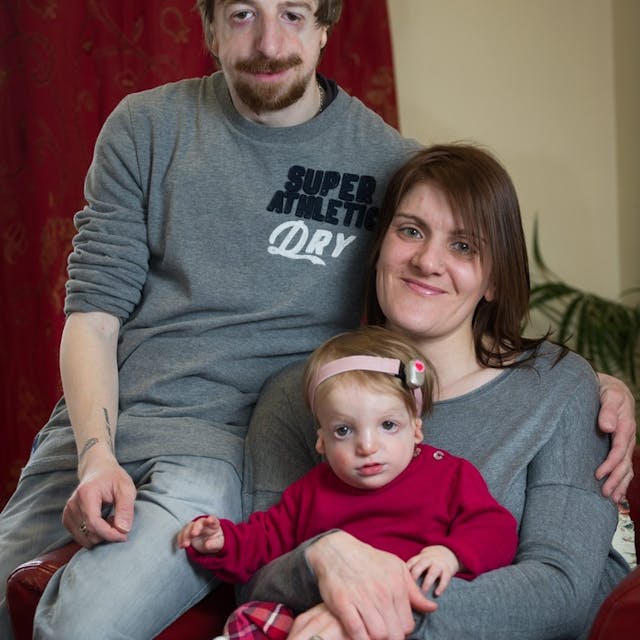 Alice Moore, 13 months who was born with the rare disease Treacher Collins Syndrome - her father Simon Moore, 30 also has the disease. Simon's wife Vicky Moore, 36 had IVF treatment to help conceive Alice as they so wanted to start a family together. See MASONS story MNFACE: A new dad with a severe facial disfigurement has defended his decision to have a baby daughter with the same condition. Simon Moore, 30, who is also profoundly deaf, has always been bullied and would hide indoors to avoid the stares of strangers. His life changed when his hearing dog Foggy, introduced him to Vicky, 36, at a sign language class five years ago and the pair married in 2012. They wanted a family so started IVF and made the decision to keep baby Alice when tests showed she also had the condition known as Treacher Collins Syndrome (TC). They had been offered a special IVF process which included state-of-the-art preimplantation genetic diagnosis to screen for the TC gene that Simon carried. The treatment would search for and destroy any embryos that carried the faulty gene. But after speaking to their family they opted for traditional IVF because they feared the screening process could leave them with no embryos.