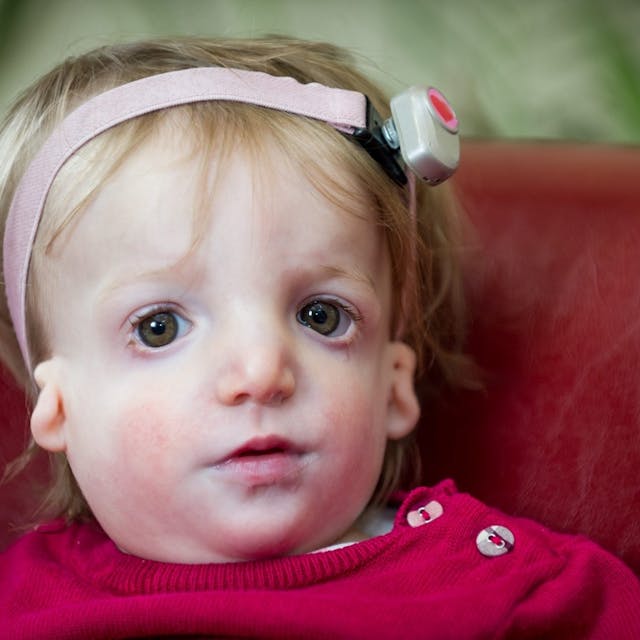 Alice Moore, 13 months who was born with the rare disease Treacher Collins Syndrome. See MASONS story MNFACE: A new dad with a severe facial disfigurement has defended his decision to have a baby daughter with the same condition. Simon Moore, 30, who is also profoundly deaf, has always been bullied and would hide indoors to avoid the stares of strangers. His life changed when his hearing dog Foggy, introduced him to Vicky, 36, at a sign language class five years ago and the pair married in 2012. They wanted a family so started IVF and made the decision to keep baby Alice when tests showed she also had the condition known as Treacher Collins Syndrome (TC). They had been offered a special IVF process which included state-of-the-art preimplantation genetic diagnosis to screen for the TC gene that Simon carried. The treatment would search for and destroy any embryos that carried the faulty gene. But after speaking to their family they opted for traditional IVF because they feared the screening process could leave them with no embryos.