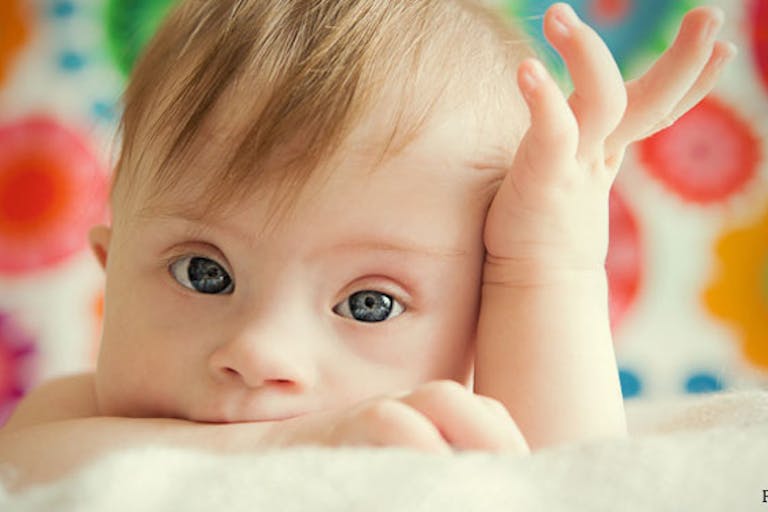 Down syndrome